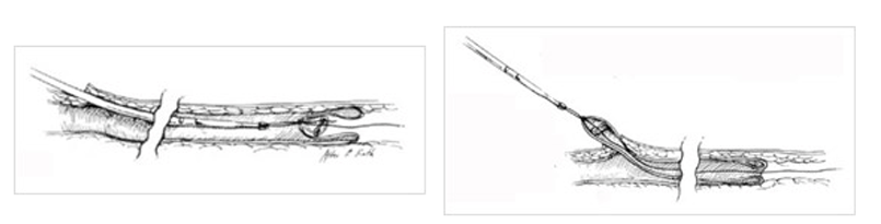 스트리핑 시술 삽화