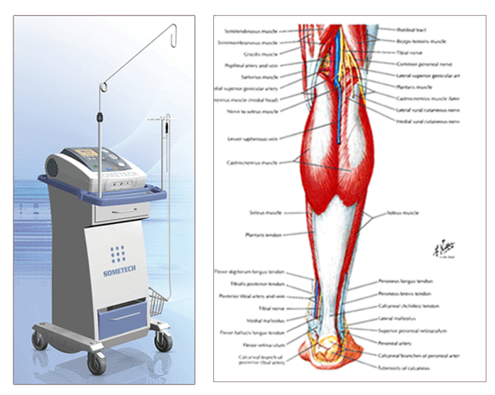 비절개 선택적 종아리 축소술
